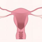 what is endometriosis