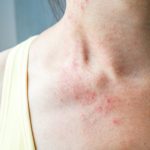 symptoms of histamine intolerance