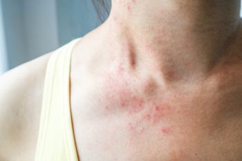 symptoms of histamine intolerance